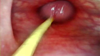 EXTREME ANAL POINT OF VIEW. WEB-CAM INSIDE HER ANUS AS I POUND HER WITH MY HUMONGOUS MEAT AND JIZZ DEEP INSIDE