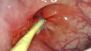 EXTREME ANAL SELF PERSPECTIVE. WEB-CAM INSIDE HER BUTTHOLE AS I POUND HER WITH MY HUMONGOUS PENIS AND SPUNK DEEP INSIDE